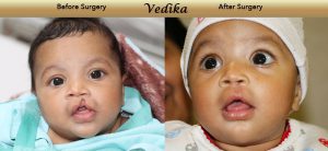 Fortis Foundation - Umeed-Smile - Four-month-old Baby Vedika Pre and Post-surgery