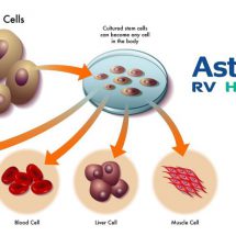 22-year-old Bangladeshi boy suffering from avascular necrosis treated with advanced stem cell regenerative technique
