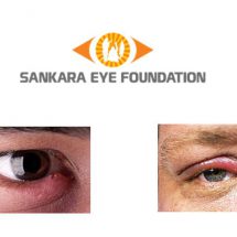 Swollen eyelid - Sankara Eye Hospital