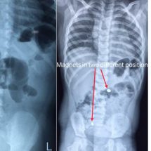 Magnets removed from 2 year old - Sakra World Hospital