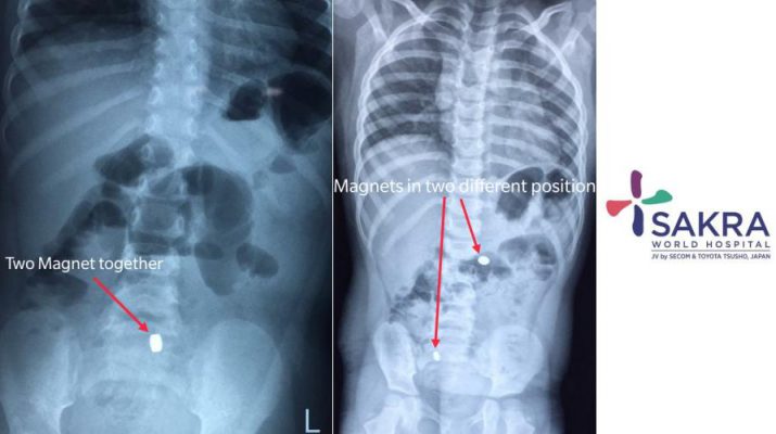Magnets removed from 2 year old - Sakra World Hospital